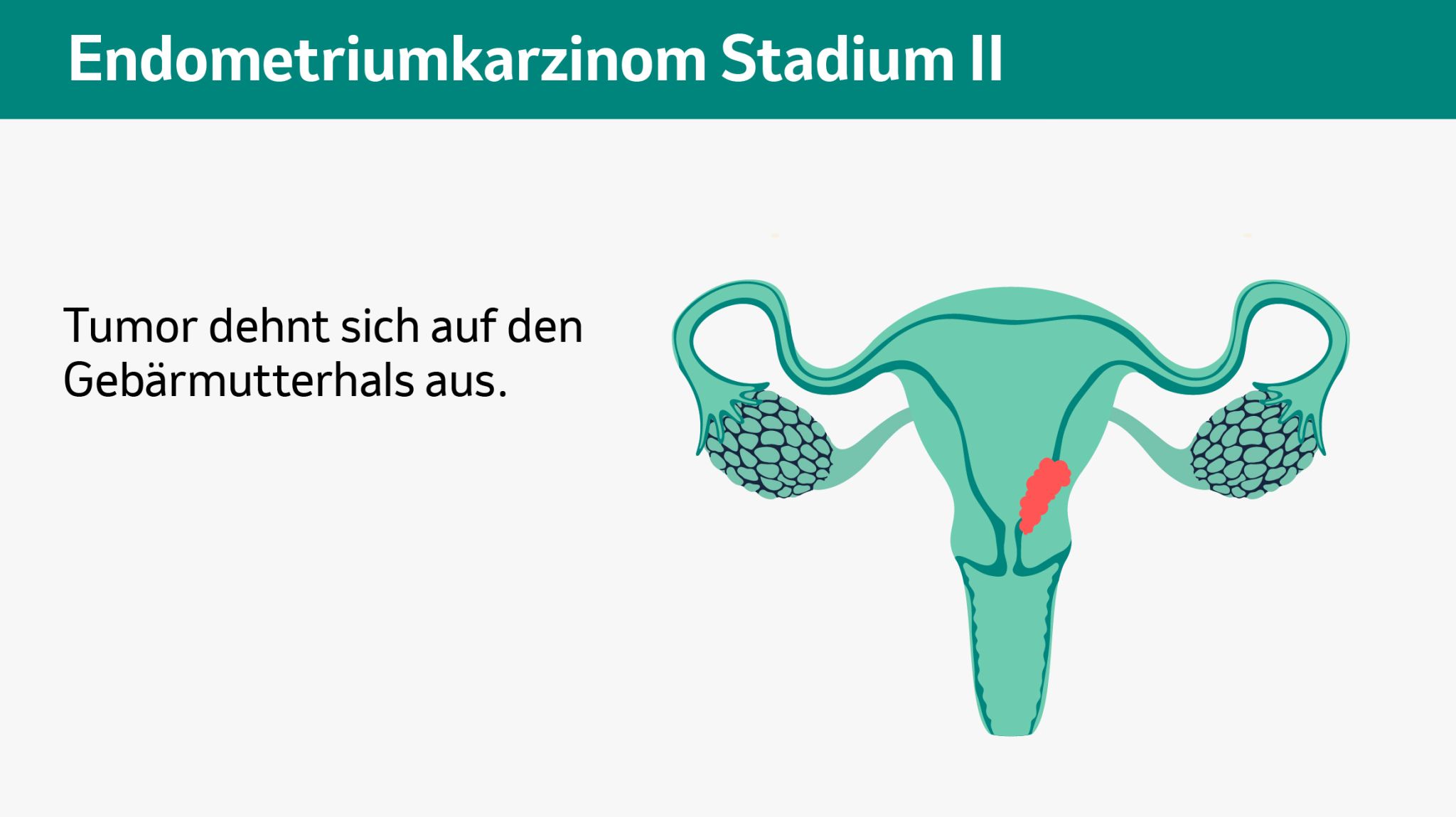 Endometriumkarzinom Stadium 2