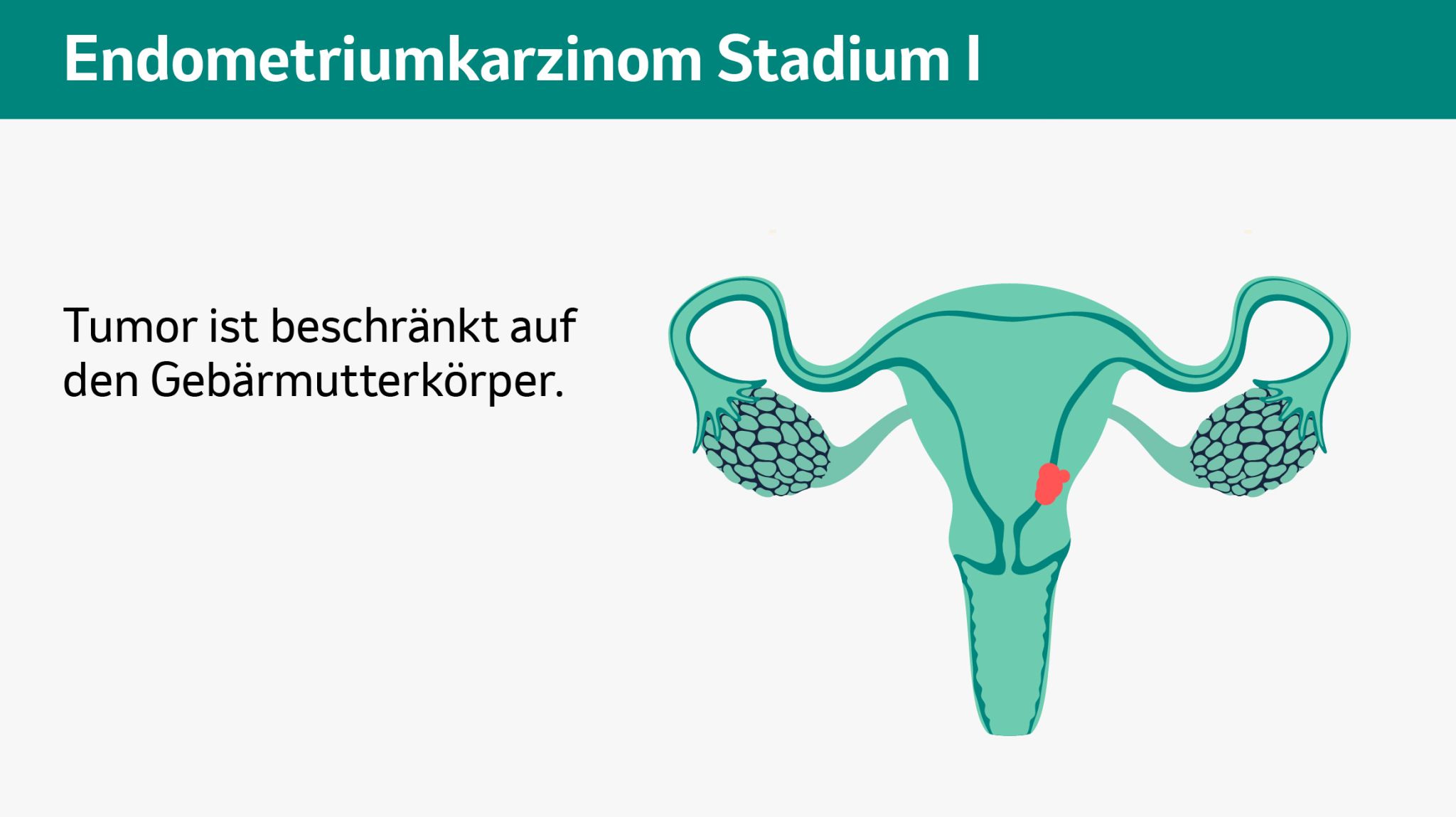 Endometriumkarzinom Stadium 1