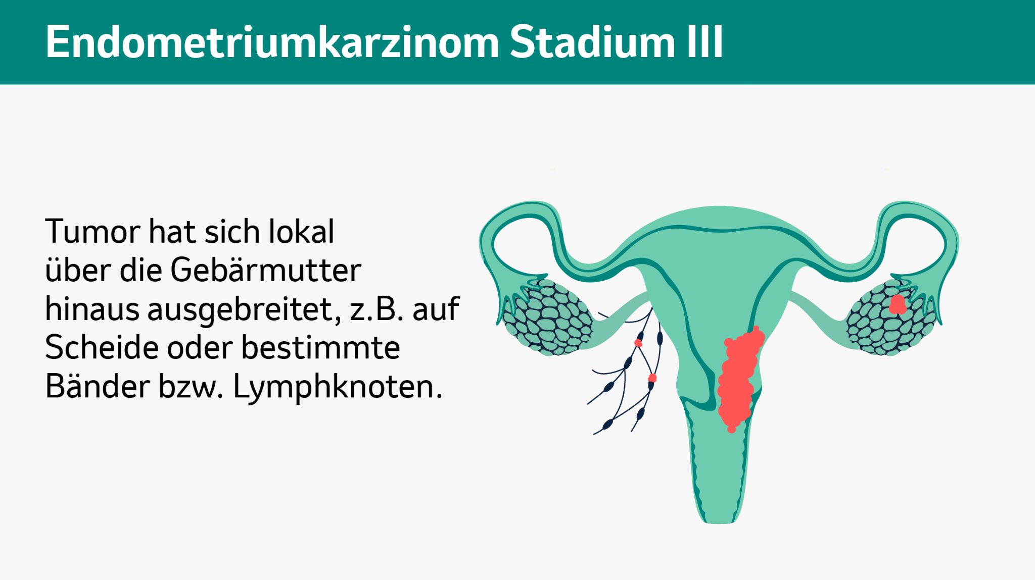 Endometriumkarzinom Stadium 3