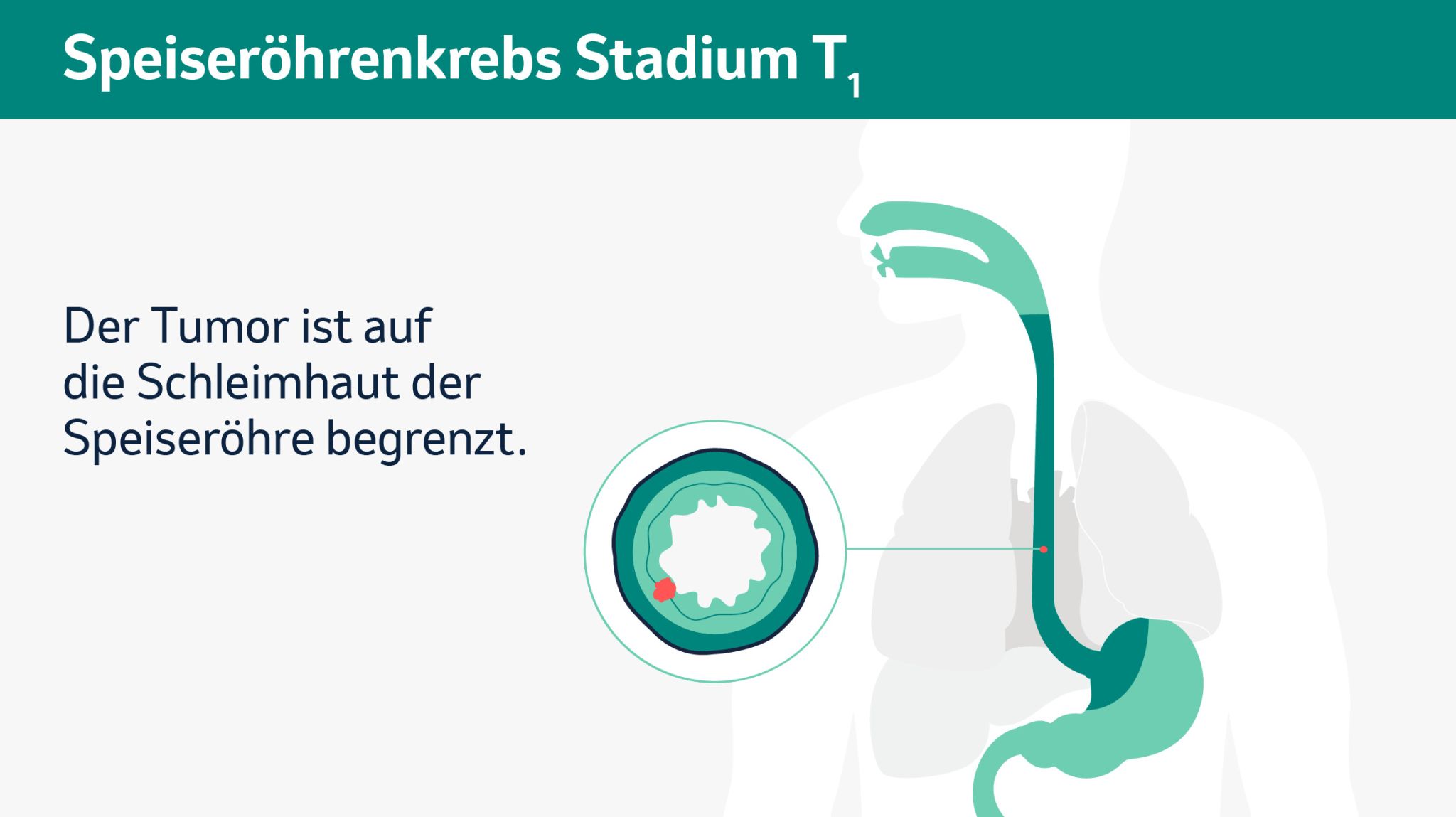 Schematische Darstellung der verschiedenen Tumorstadien in einem Querschnitt. 
