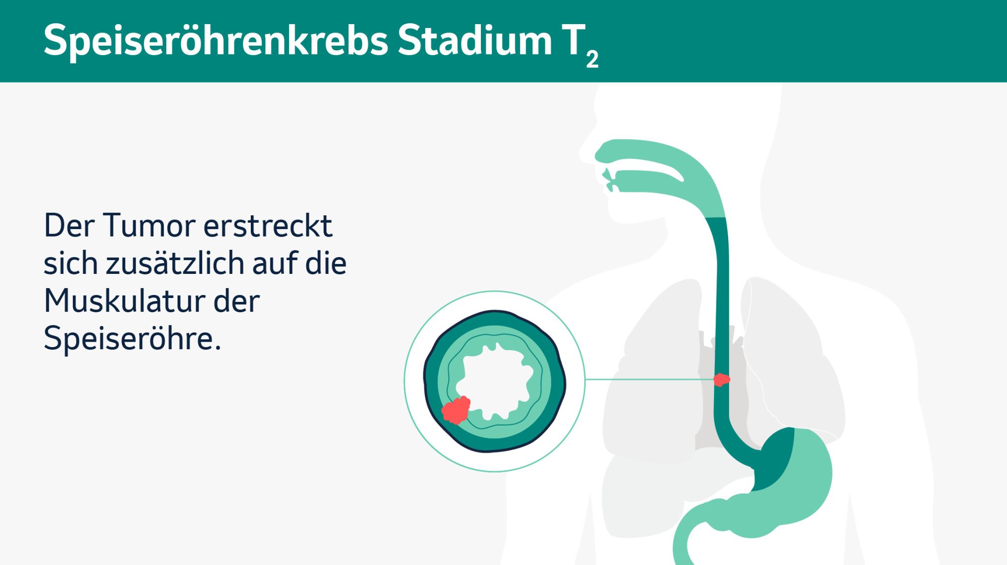 Schematische Darstellung der verschiedenen Tumorstadien in einem Querschnitt. 

