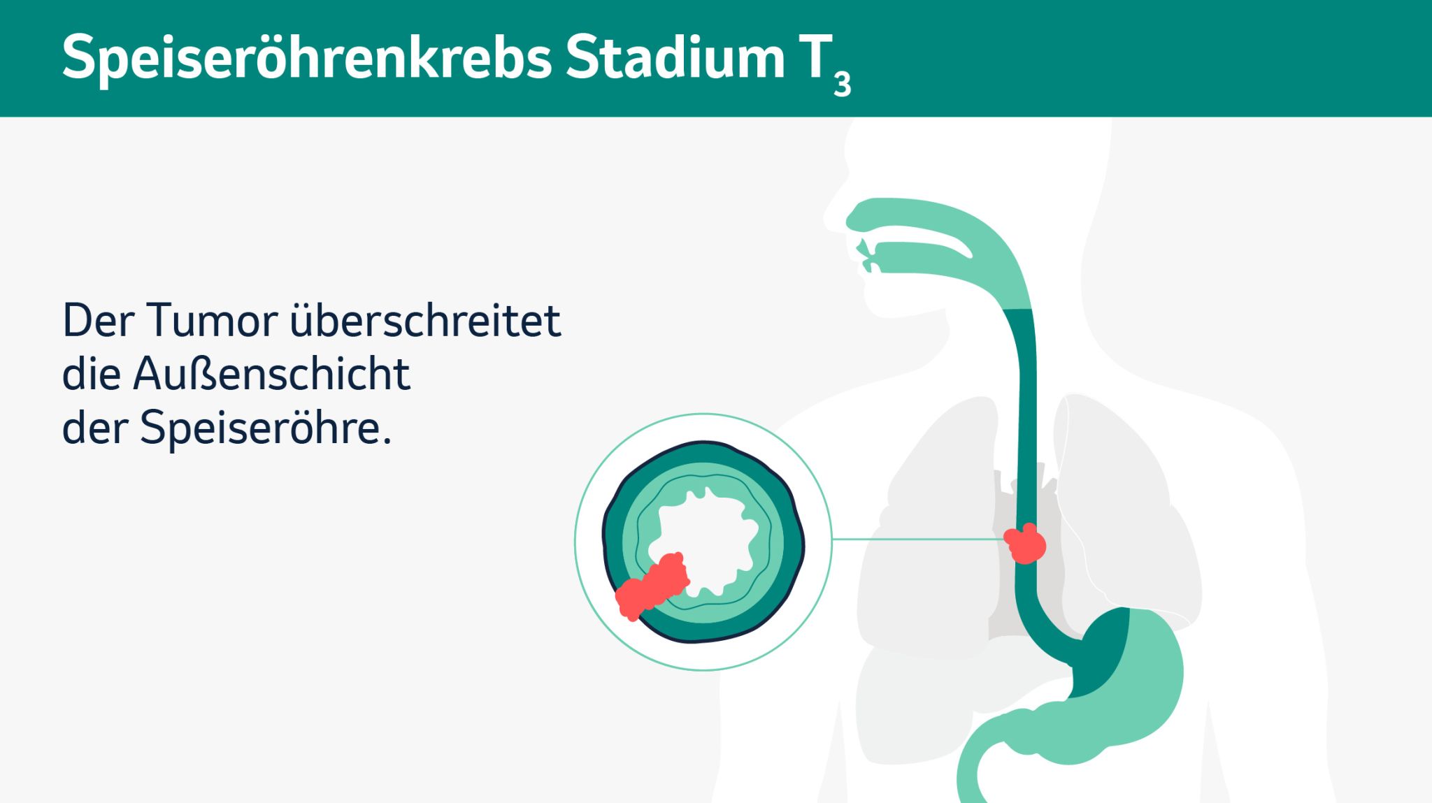 Schematische Darstellung der verschiedenen Tumorstadien in einem Querschnitt. 

