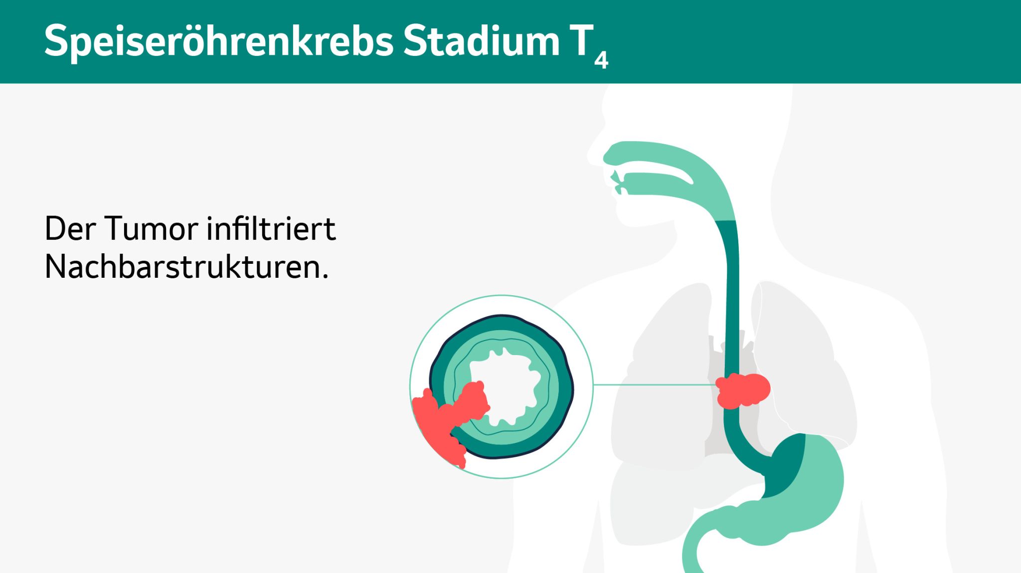 Schematische Darstellung der verschiedenen Tumorstadien in einem Querschnitt. 
