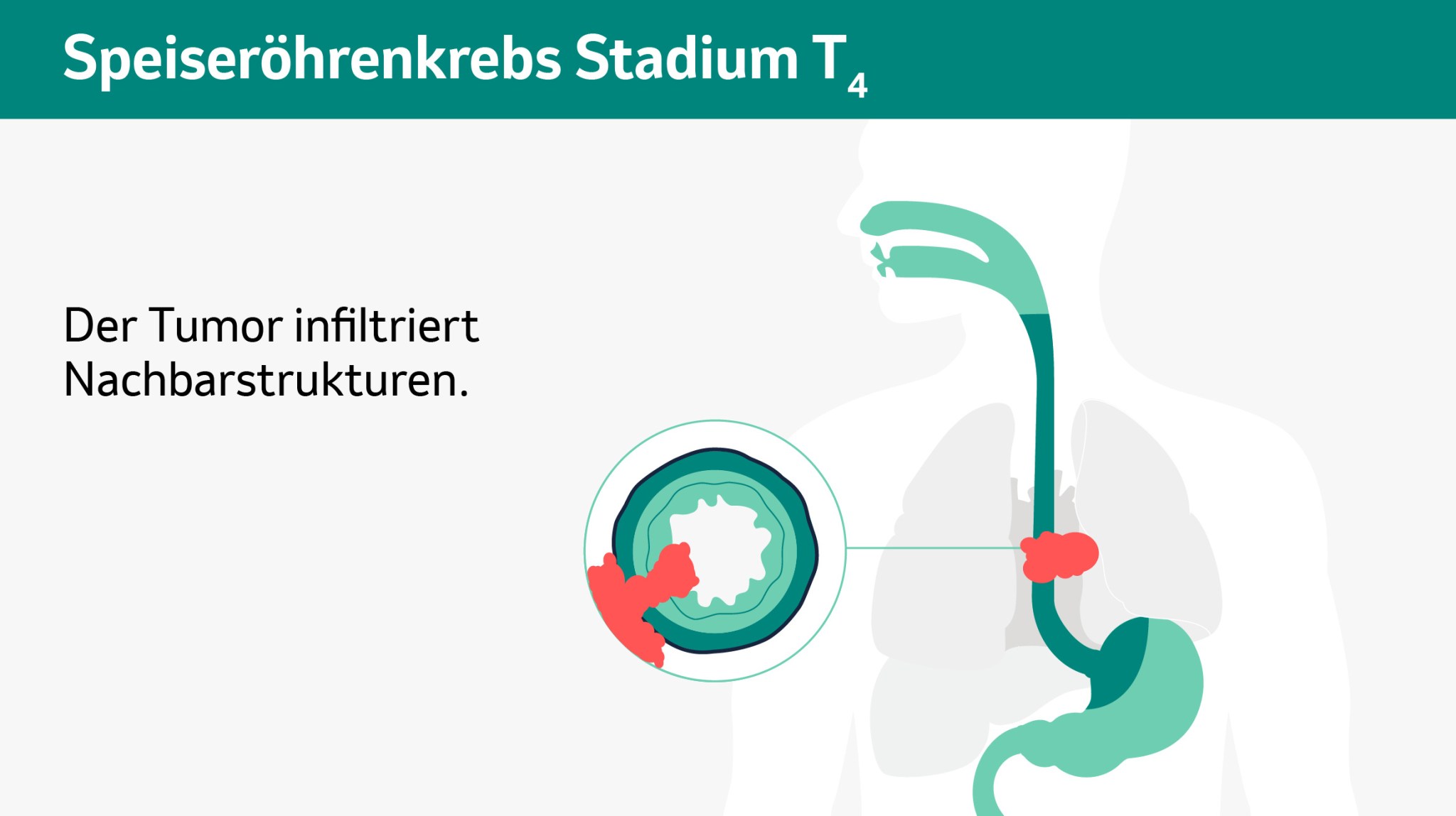 Schematische Darstellung der verschiedenen Tumorstadien in einem Querschnitt. 
