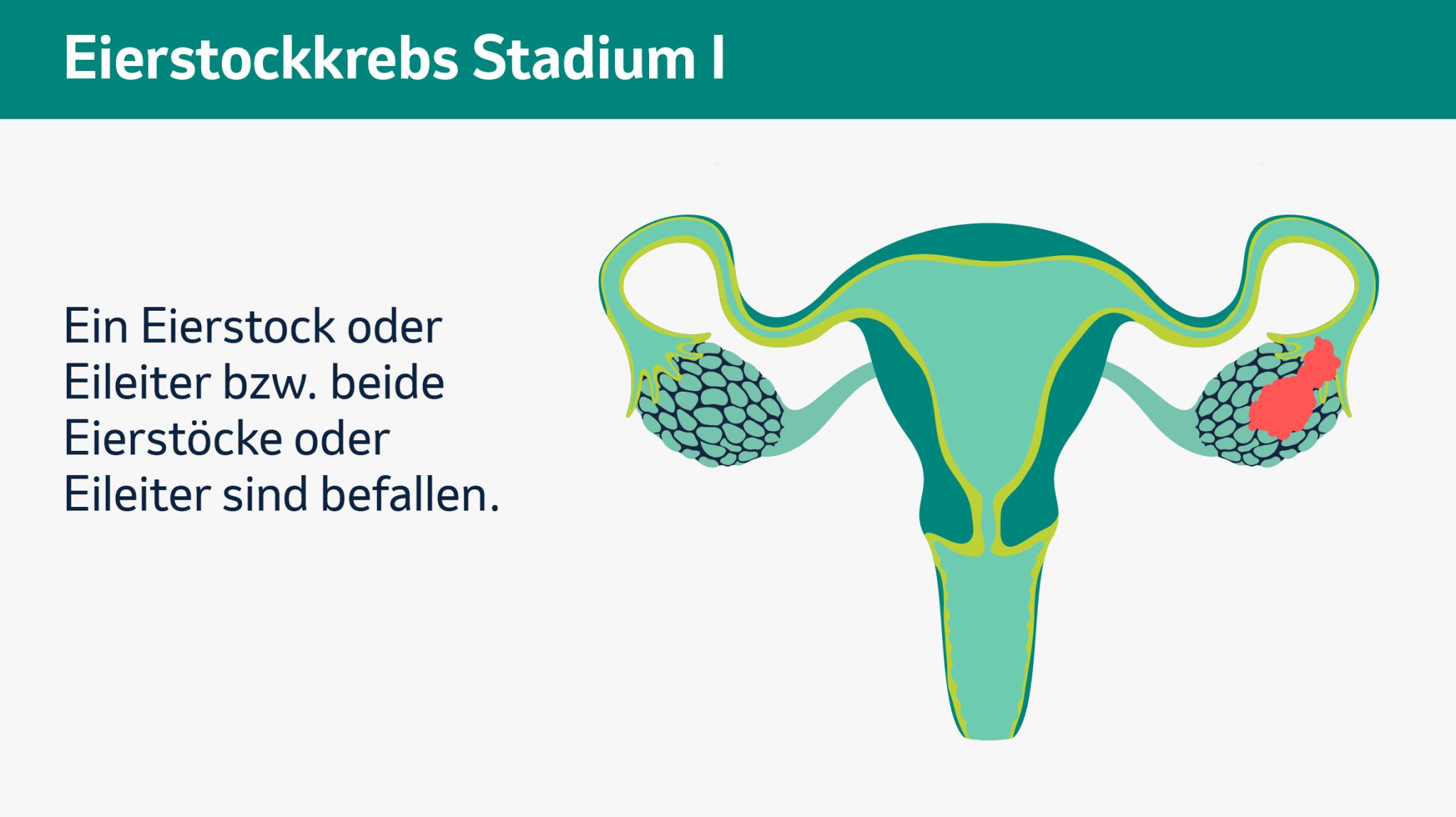 Stadium 1: Ein Eierstock oder Eileiter bzw. beide Eierstöcke oder Eileiter sind betroffen.