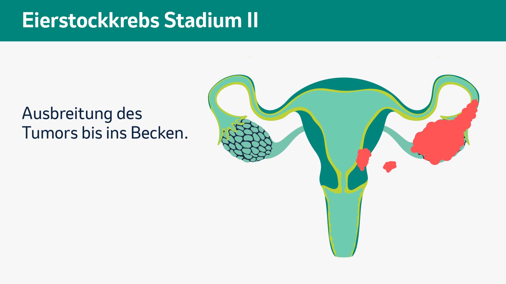 Stadium 2: Ausbreitung des Tumors bis ins Becken.