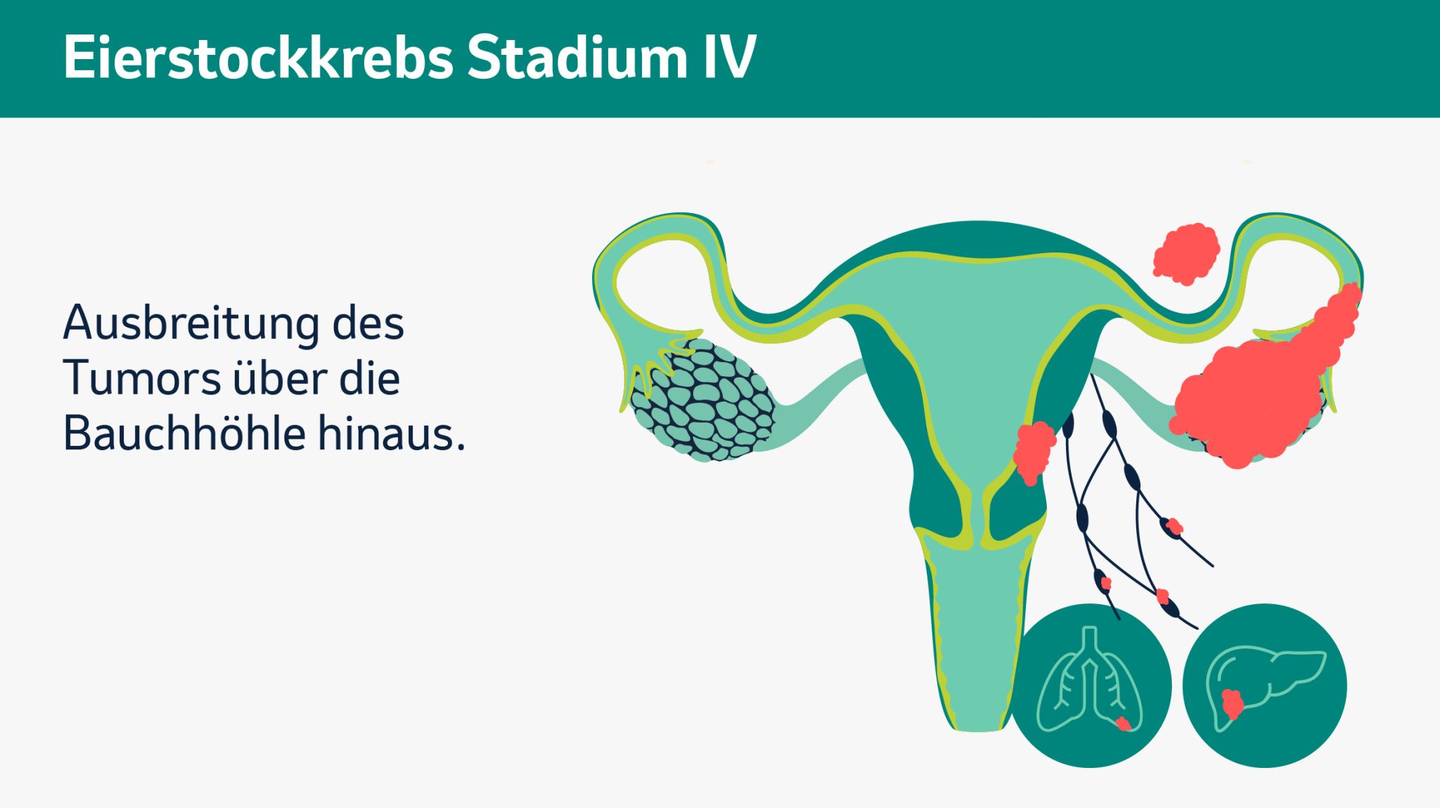 Stadium 4: Ausbreitung des Tumors über die Bauchhöhle hinaus.