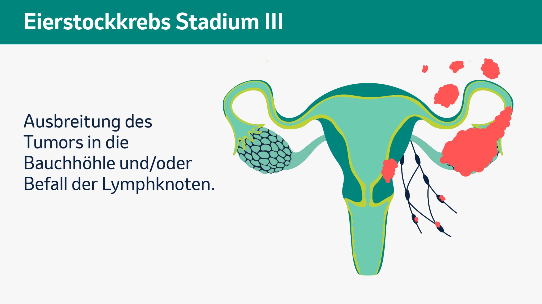 Stadium 3: Ausbreitung des Tumors in die Bauchhöhle oder Befall der Lymphknoten.