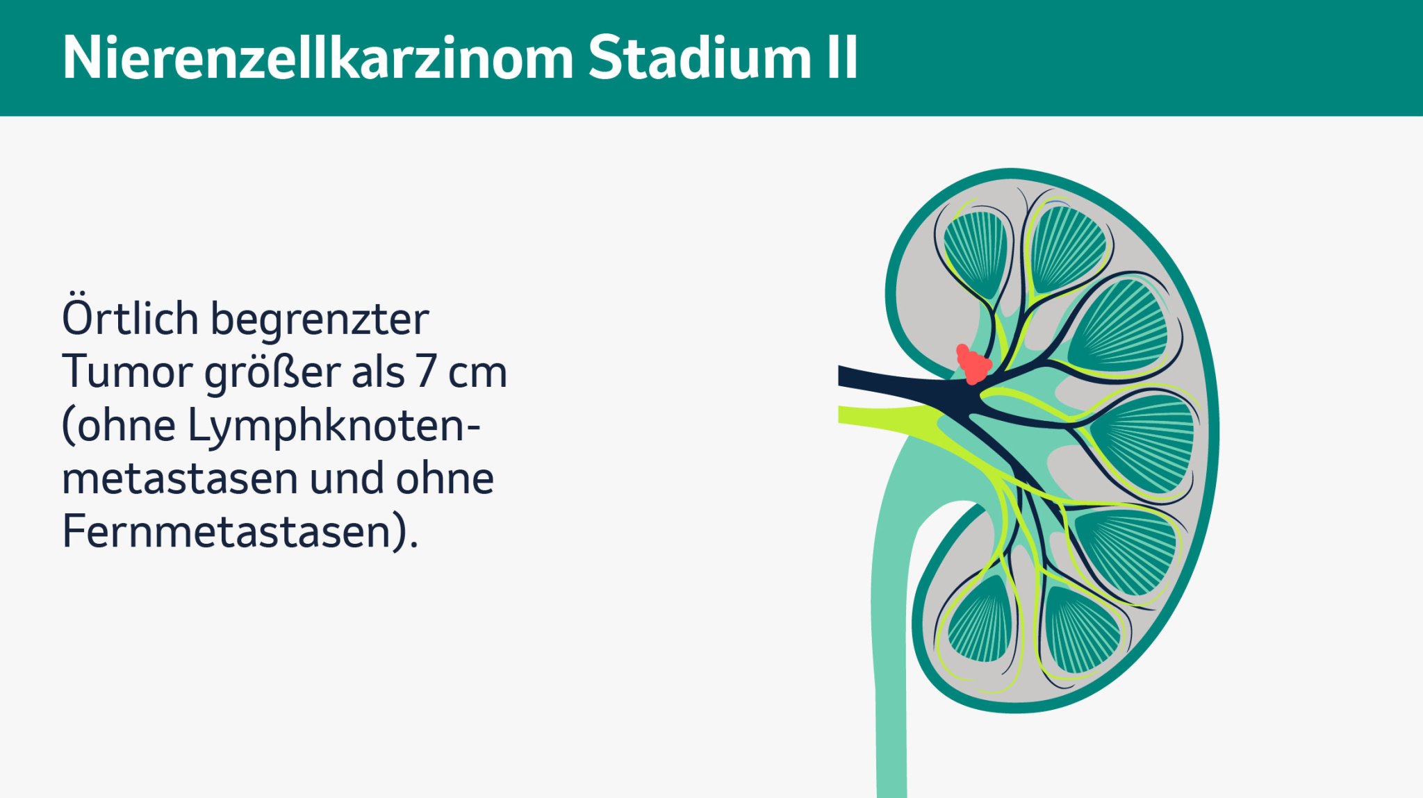 Vier Abbildungen zeigen unterschiedliche Stadien von Nierenkrebs, Stadien I bis IV. Jede der Abbildungen zeigt eine schematische Darstellung einer menschlichen Niere im Querschnitt. Zu sehen sind die Nierenkapsel, Nierenpyramiden, Nierenrinde, Nierenkelche, Nierenarterie, Nierenvene, Nierenbecken und der Harnleiter. Die verschiedenen Bereiche sind farblich voneinander abgehoben, um ihre Funktionen visuell zu verdeutlichen. Stadium I zeigt einen auf die Niere begrenzten Tumor bis zu einer Größe von 7cm, welcher in roter Farbe am Nierenkelch eingezeichnet ist. Stadium II zeigt einen örtlich begrenzten Tumor größer als 7cm (ohne Lymphknotenmetastasen und ohne Fernmetastasen), welcher in roter Farbe, etwas größer als im vorherigen Stadium, am Nierenkelch eingezeichnet ist. Stadium III zeigt einen kleinen Tumor mit Lymphknotenmetastasen sowie einen großen Tumor (mit oder ohne Lymphknotenmetastasen), welche an Nierenkelch und Nierenvene eingezeichnet sind (beide ohne Fernmetastasen). Stadium IV zeigt dieselben Tumoren mit Fernmetastasen, welche am Beispiel eines Gehirns gezeigt werden, unabhängig von der Größe. Stadium IV kann auch einen Tumor beschreiben, der über die Fettkapsel der Niere gewachsen ist oder in die Nebenniere eindringt. 