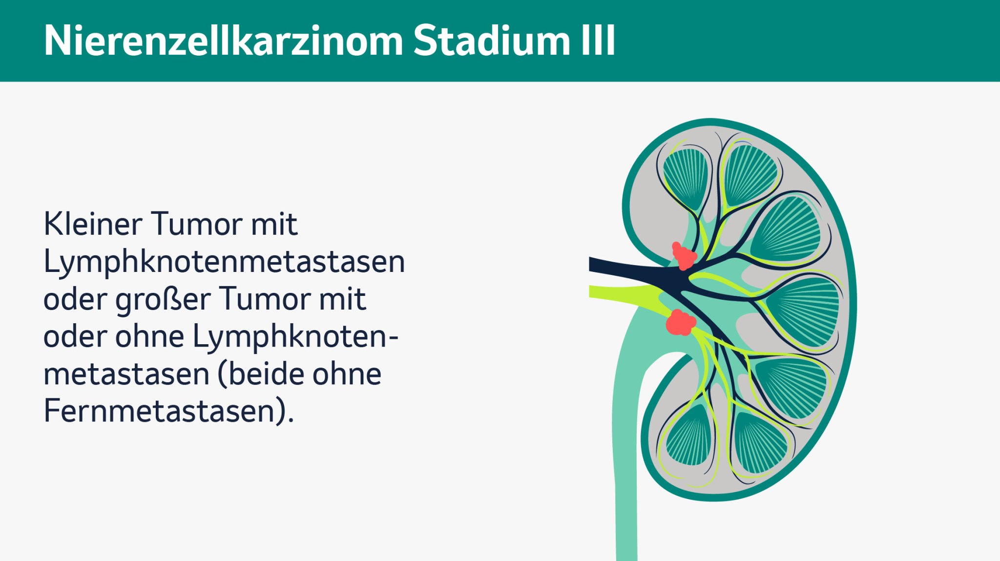 Vier Abbildungen zeigen unterschiedliche Stadien von Nierenkrebs, Stadien I bis IV. Jede der Abbildungen zeigt eine schematische Darstellung einer menschlichen Niere im Querschnitt. Zu sehen sind die Nierenkapsel, Nierenpyramiden, Nierenrinde, Nierenkelche, Nierenarterie, Nierenvene, Nierenbecken und der Harnleiter. Die verschiedenen Bereiche sind farblich voneinander abgehoben, um ihre Funktionen visuell zu verdeutlichen. Stadium I zeigt einen auf die Niere begrenzten Tumor bis zu einer Größe von 7cm, welcher in roter Farbe am Nierenkelch eingezeichnet ist. Stadium II zeigt einen örtlich begrenzten Tumor größer als 7cm (ohne Lymphknotenmetastasen und ohne Fernmetastasen), welcher in roter Farbe, etwas größer als im vorherigen Stadium, am Nierenkelch eingezeichnet ist. Stadium III zeigt einen kleinen Tumor mit Lymphknotenmetastasen sowie einen großen Tumor (mit oder ohne Lymphknotenmetastasen), welche an Nierenkelch und Nierenvene eingezeichnet sind (beide ohne Fernmetastasen). Stadium IV zeigt dieselben Tumoren mit Fernmetastasen, welche am Beispiel eines Gehirns gezeigt werden, unabhängig von der Größe. Stadium IV kann auch einen Tumor beschreiben, der über die Fettkapsel der Niere gewachsen ist oder in die Nebenniere eindringt. 