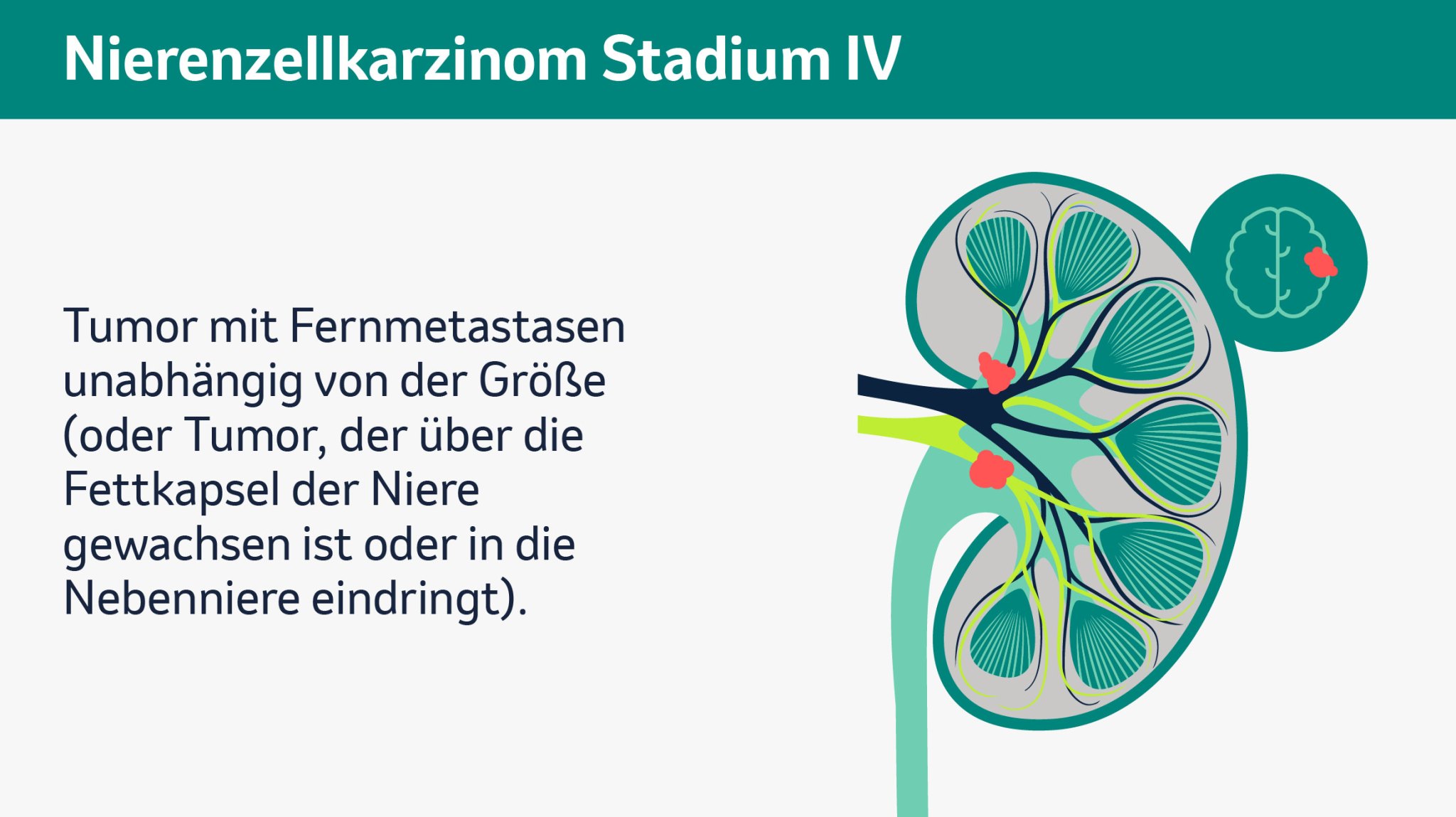 Vier Abbildungen zeigen unterschiedliche Stadien von Nierenkrebs, Stadien I bis IV. Jede der Abbildungen zeigt eine schematische Darstellung einer menschlichen Niere im Querschnitt. Zu sehen sind die Nierenkapsel, Nierenpyramiden, Nierenrinde, Nierenkelche, Nierenarterie, Nierenvene, Nierenbecken und der Harnleiter. Die verschiedenen Bereiche sind farblich voneinander abgehoben, um ihre Funktionen visuell zu verdeutlichen. Stadium I zeigt einen auf die Niere begrenzten Tumor bis zu einer Größe von 7cm, welcher in roter Farbe am Nierenkelch eingezeichnet ist. Stadium II zeigt einen örtlich begrenzten Tumor größer als 7cm (ohne Lymphknotenmetastasen und ohne Fernmetastasen), welcher in roter Farbe, etwas größer als im vorherigen Stadium, am Nierenkelch eingezeichnet ist. Stadium III zeigt einen kleinen Tumor mit Lymphknotenmetastasen sowie einen großen Tumor (mit oder ohne Lymphknotenmetastasen), welche an Nierenkelch und Nierenvene eingezeichnet sind (beide ohne Fernmetastasen). Stadium IV zeigt dieselben Tumoren mit Fernmetastasen, welche am Beispiel eines Gehirns gezeigt werden, unabhängig von der Größe. Stadium IV kann auch einen Tumor beschreiben, der über die Fettkapsel der Niere gewachsen ist oder in die Nebenniere eindringt. 