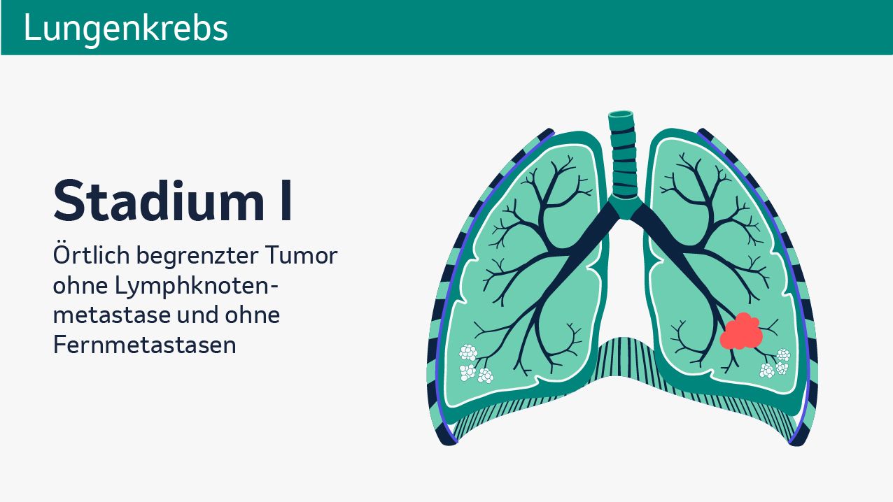 In der Abbildung ist eine vereinfachte, schematische Darstellung der Lunge zu sehen. Im unteren linken Lungenflügel ist in Rot die schematische Darstellung eines Tumors zu sehen. Im linken Teil der Abbildung steht folgender Text: Stadium I. Örtlich begrenzter Tumor ohne Lymphknotenmetastasen und ohne Fernmetastasen.