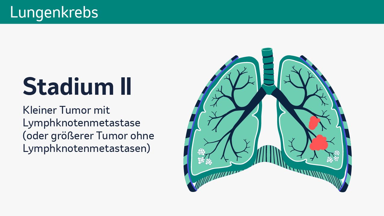 In der Abbildung ist eine vereinfachte, schematische Darstellung der Lunge zu sehen. Im unteren linken Lungenflügel sind in Rot die schematische Darstellung von einem Tumor und einer Metastase zu sehen. Im linken Teil der Abbildung steht folgender Text: Stadium II. Kleiner Tumor mit Lymphknotenmetastase oder größerer Tumor ohne Lymphknotenmetastase.
