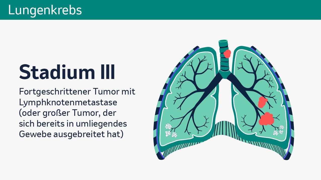 In der Abbildung ist eine vereinfachte, schematische Darstellung der Lunge zu sehen. Im unteren linken Lungenflügel sind in Rot die schematische Darstellung von einem Tumor und einer Metastase zu sehen. Im Bereich der aufsteigenden Luftröhre ist ebenfalls eine in Rot dargestellte Metastase zu sehen. Im linken Teil der Abbildung steht folgender Text: Stadium III. Fortgeschrittener Tumor mit Lymphknotenmetastase oder großer Tumor, der sich bereits in umliegendes Gewebe ausgebreitet hat.