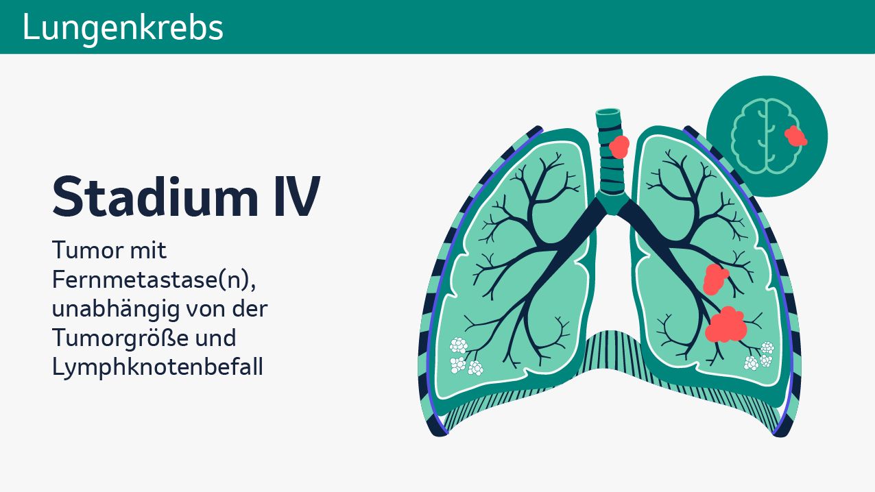 In der Abbildung ist eine vereinfachte, schematische Darstellung der Lunge zu sehen. Im unteren linken Lungenflügel ist in Rot die schematische Darstellung von einem Tumor und einer Metastase zu sehen. Im Bereich der aufsteigenden Luftröhre ist ebenfalls eine in Rot dargestellte Metastase zu sehen. Im oberen Rand der Lunge ist eine schematische Darstellung des Gehirns, inklusive einer in Rot dargestellten Metastase zu sehen. Im linken Teil der Abbildung steht folgender Text: Stadium IV. Tumor mit Fernmetastase(n), unabhängig von der Tumorgröße und Lymphknotenbefall.
